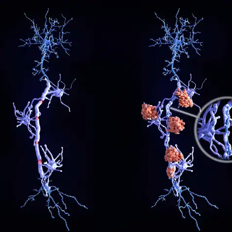 Trouver un courtier sp�cialis� dans les risques aggrav�s pour personne atteinte de scl�rose en plaque � Toulouse en Haute-Garonne 31